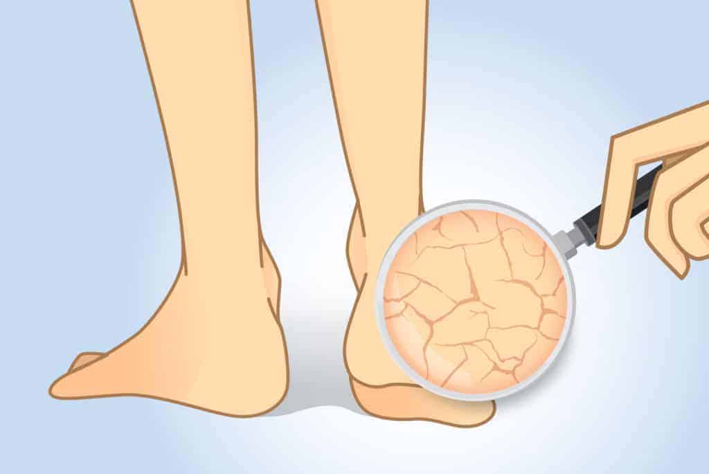 remove dry skin from feet